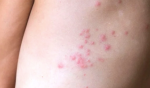 " image of bed bug bite"